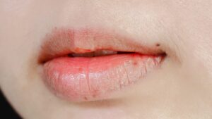 唇の皮がむける原因は？乾燥だけじゃない“意外な理由”と今すぐできる対策法