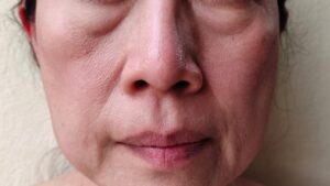 目の下の脂肪は自力で減らせる？｜原因と対策、治療法との違いも徹底解説