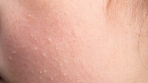【なぜ頬だけ？】肌がざらざらする原因とスキンケアの見直しポイントを徹底解説