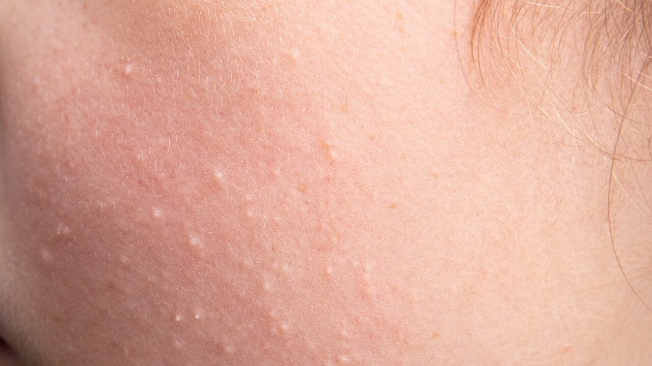 【なぜ頬だけ？】肌がざらざらする原因とスキンケアの見直しポイントを徹底解説