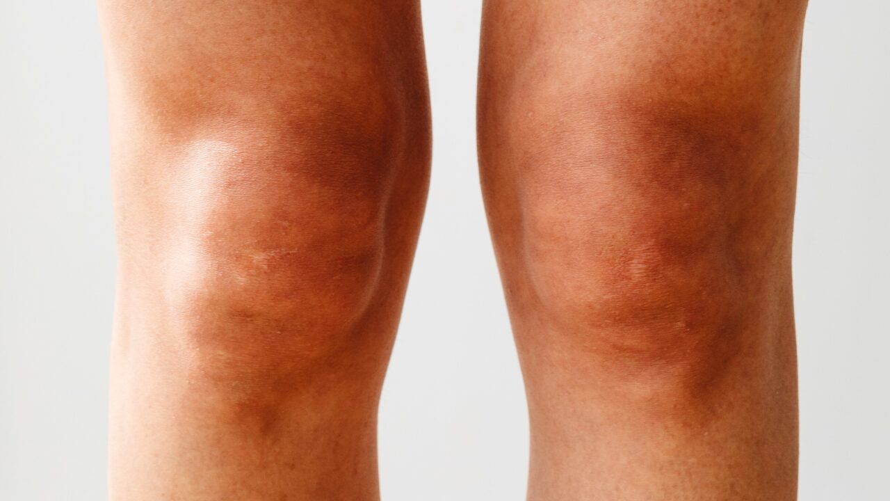 膝の黒ずみはピーリングで治る？効果・注意点と正しいケア方法を徹底解説！