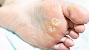 足裏の角質を取りすぎた！ヒリヒリ痛い…正しい対処法とNG行動まとめ