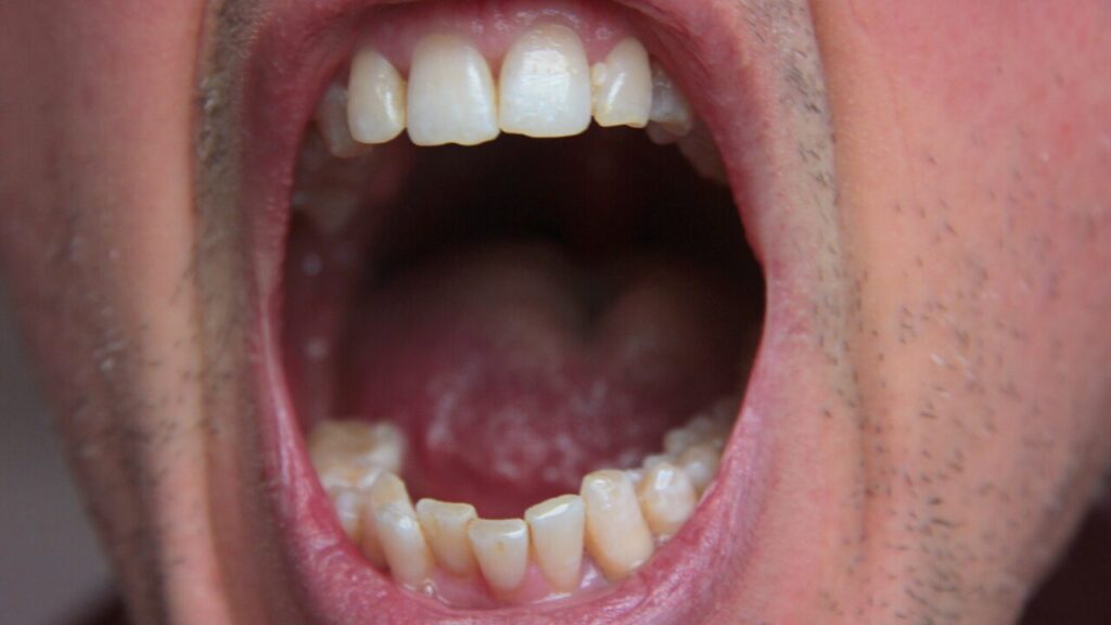 口の端が切れて治らない…その原因と正しいケア・悪化を防ぐ注意点まとめ