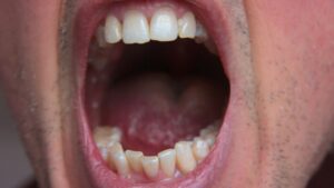 口の端が切れて治らない…その原因と正しいケア・悪化を防ぐ注意点まとめ
