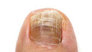 足の爪が分厚くなってきた…原因と自宅でできる安全な削り方＆注意点まとめ