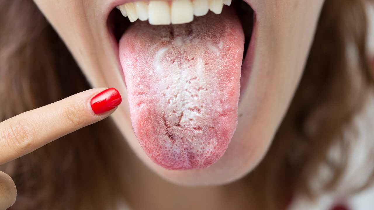 舌が白いのが取れない…病気のサイン？考えられる原因とケア方法を徹底解説！