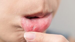 口の中の皮がむける原因は？ストレス・ビタミン不足との関係も解説！