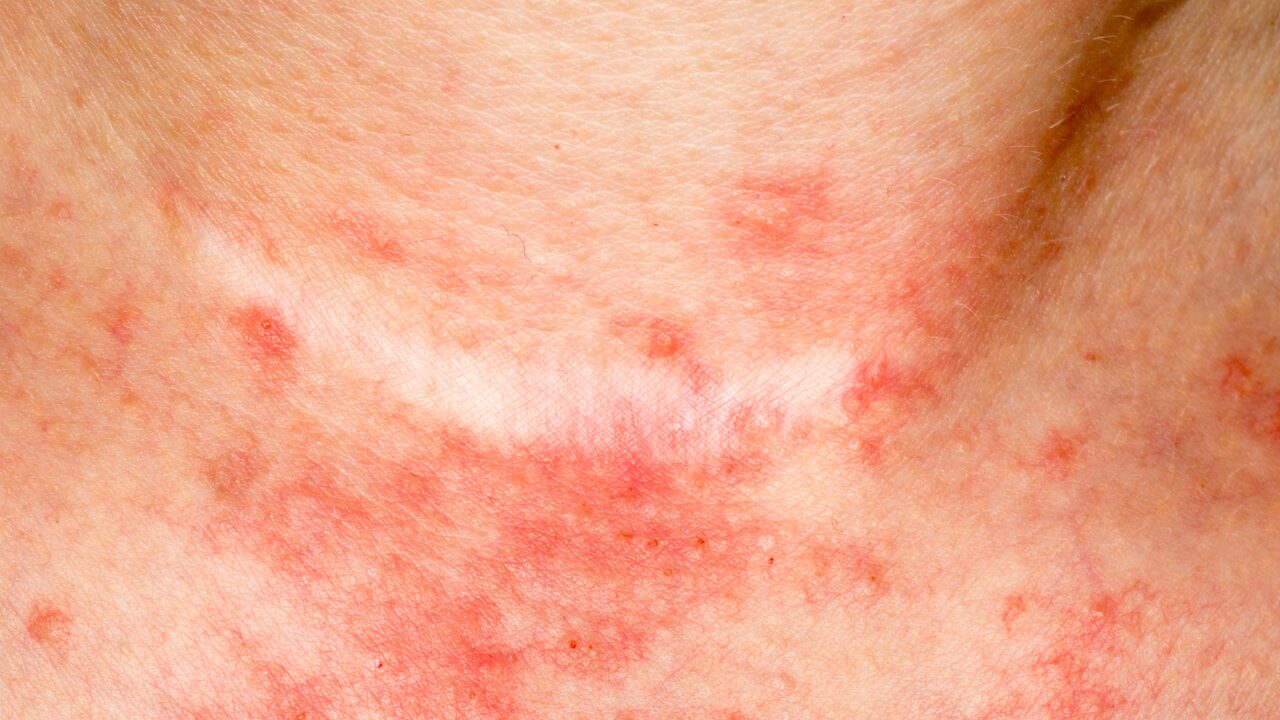 首だけ肌荒れするのはなぜ？原因と見直すべき生活習慣を徹底解説！