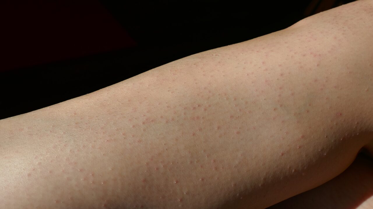 二の腕の毛穴ぶつぶつ対策｜つるすべ肌になる習慣とは？