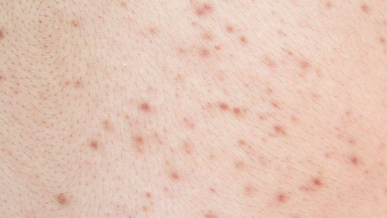 自宅でできる！背中ニキビ跡を消す簡単ケア法