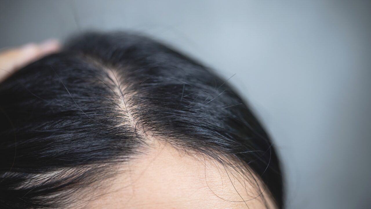 【女性の分け目薄毛対策】目立たないヘアスタイル＆簡単セルフケア術まとめ！今すぐできる隠し方とは？