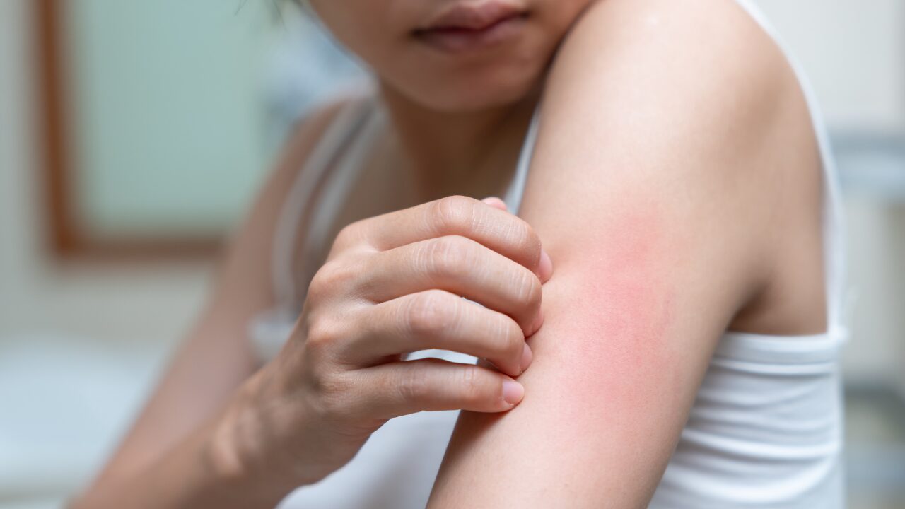 季節の変わり目あるある｜肌トラブルの主な症状