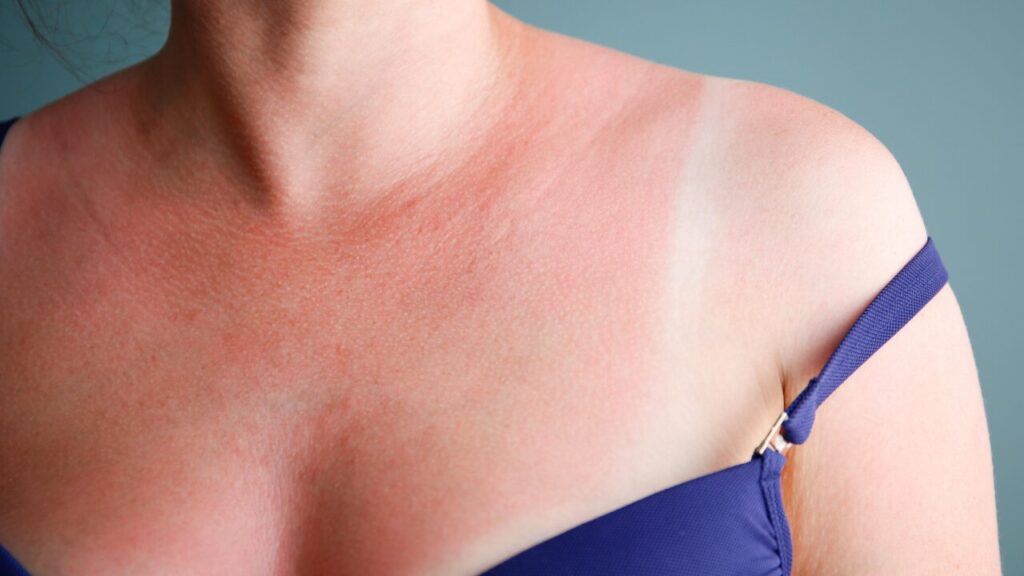 デコルテの日焼けあとを消したい！美白×保湿のWケアで透明感を取り戻す方法