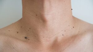 首のイボを自宅でケアする方法｜原因・対処法・やってはいけないことまで解説！