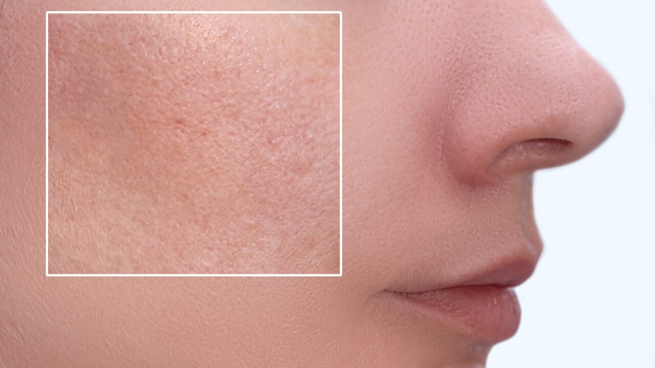 頬の毛穴を引き締めるには？開き毛穴に効くスキンケア＆生活習慣を徹底解説！
