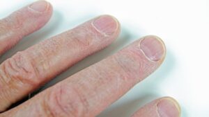 指先の乾燥・ひび割れを改善！今すぐできる保湿ケアと予防法