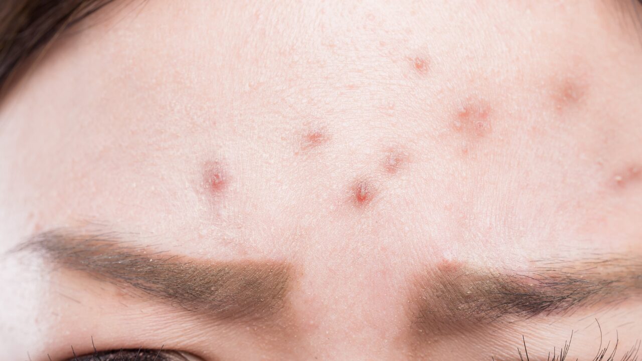 おでこのニキビと皮むけ、同時に起きる原因は？正しい治し方＆スキンケアのコツを徹底解説