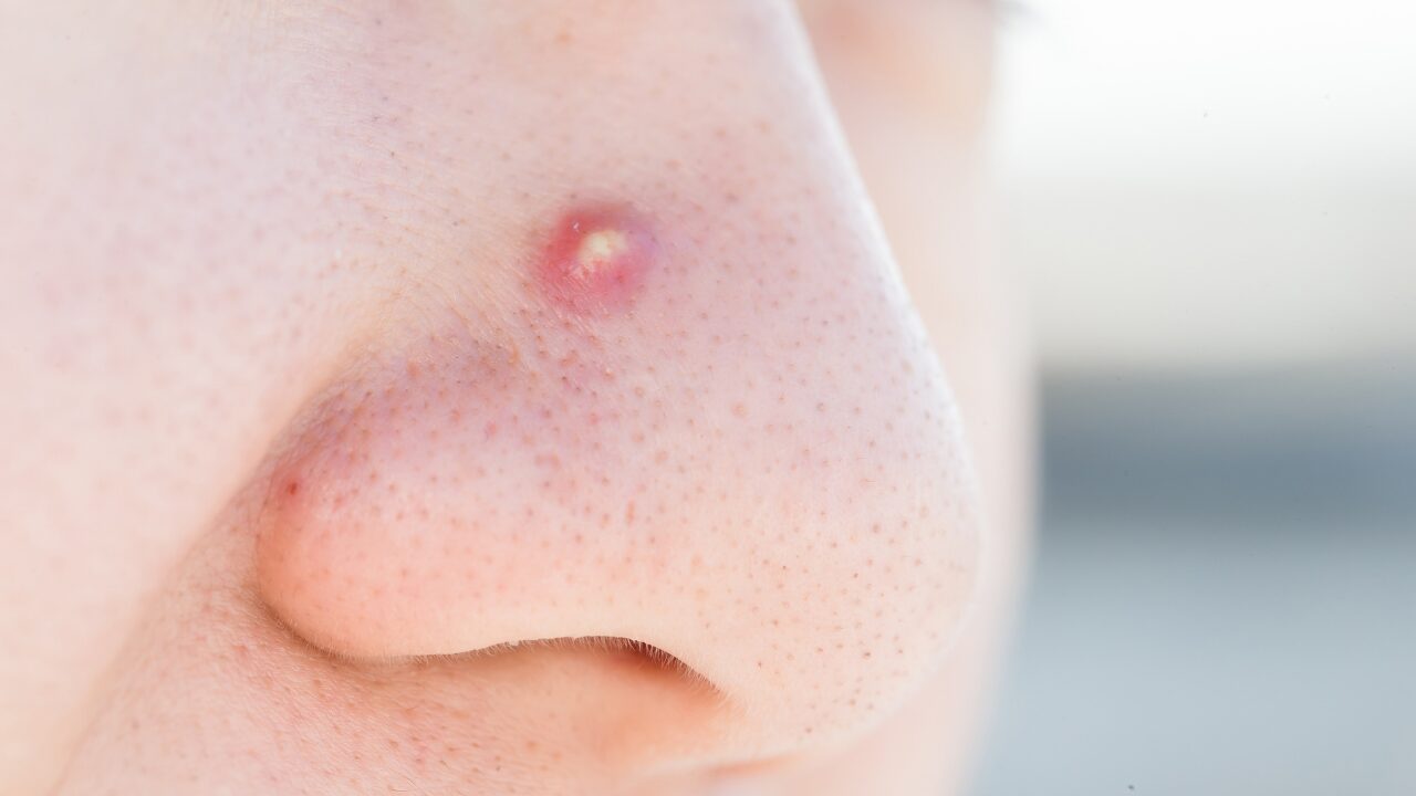 繰り返す鼻ニキビを防ぐには？見直すべき生活習慣