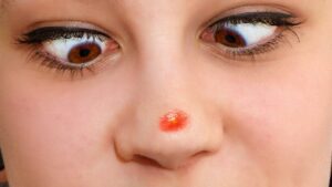 鼻の頭だけニキビができる原因と治し方｜繰り返す理由と今すぐできる対策法