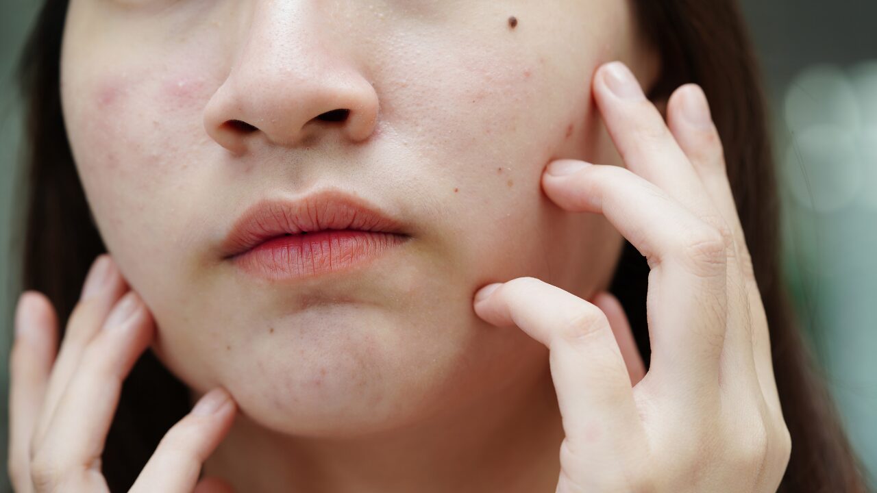 まとめ｜おでこのぶつぶつ対策は「原因特定」と「やさしいケア」から