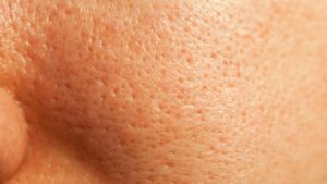 頬やあごの毛穴が目立つ…実は逆効果？やりがちなNGケア＆正しい対策とは