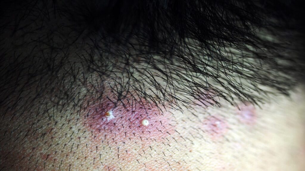 頭皮ニキビを改善するシャンプーの選び方｜原因から対処法まで徹底解説！