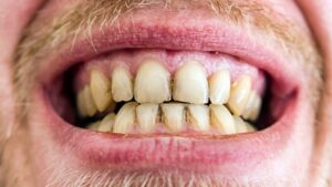 歯の黄ばみを防ぐ食べ物＆原因になる食品リスト｜白い歯を保つための生活習慣も解説