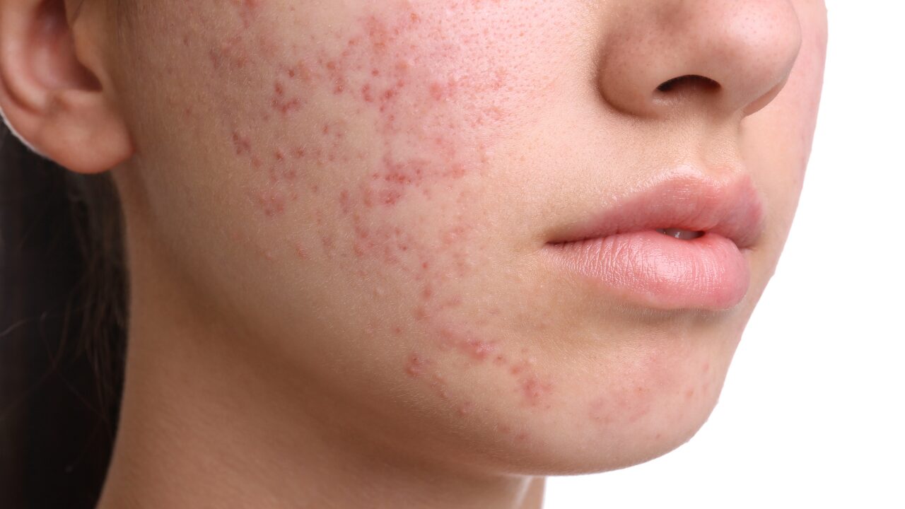 洗顔だけじゃない！ニキビを防ぐためのスキンケア習慣
