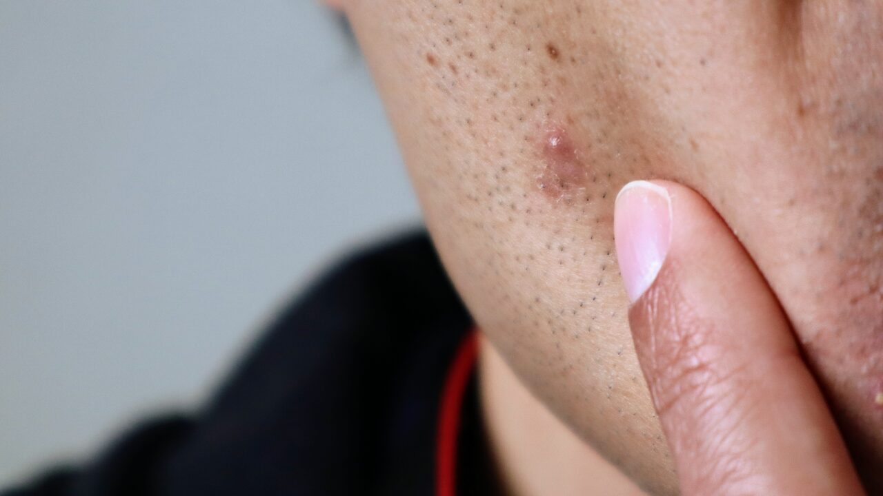 男性の肌荒れ対策は「食生活＆生活習慣の見直し」がカギ！今日からできる改善法を紹介