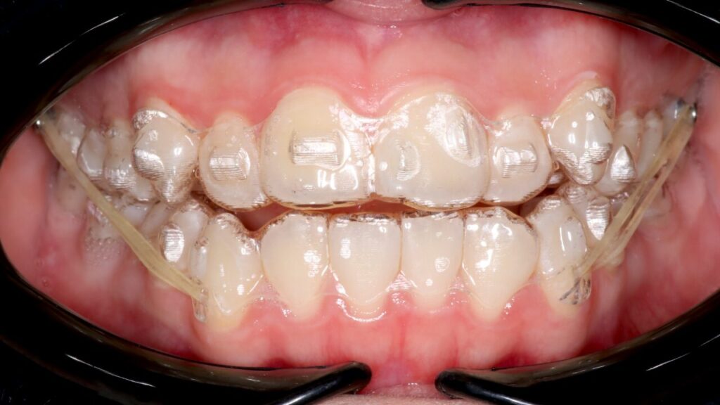 こんな人にウィスマイルのマウスピース矯正はおすすめ