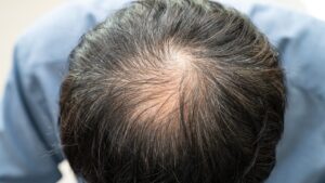 【AGA治療】ゴリラクリニックの効果と料金を徹底解説｜初回2,980円の発毛治療は本当にお得？